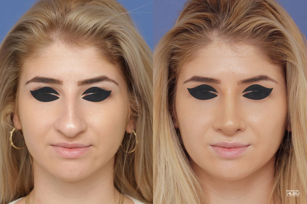 Caz 2. Rinoplastie primară. Septoplastie. Rezultat față.