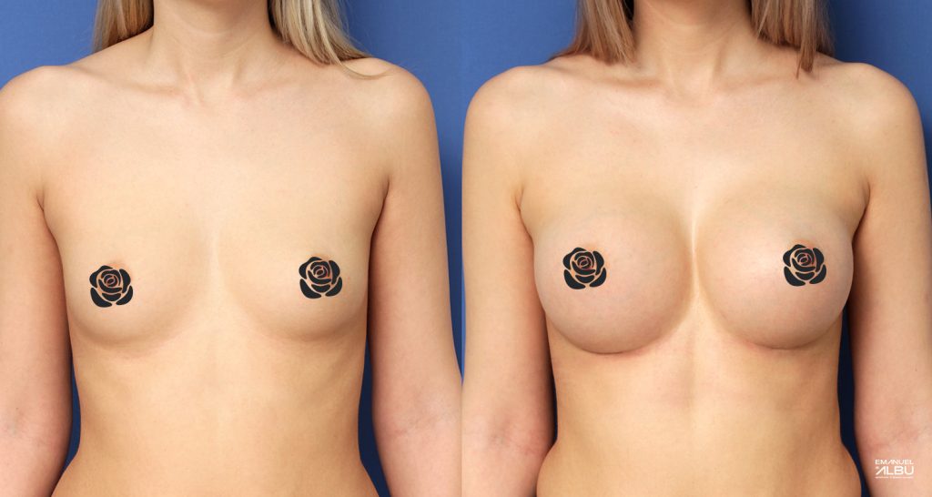 Caz 3. Implant mamar 290 cc. Silicoane bust față.