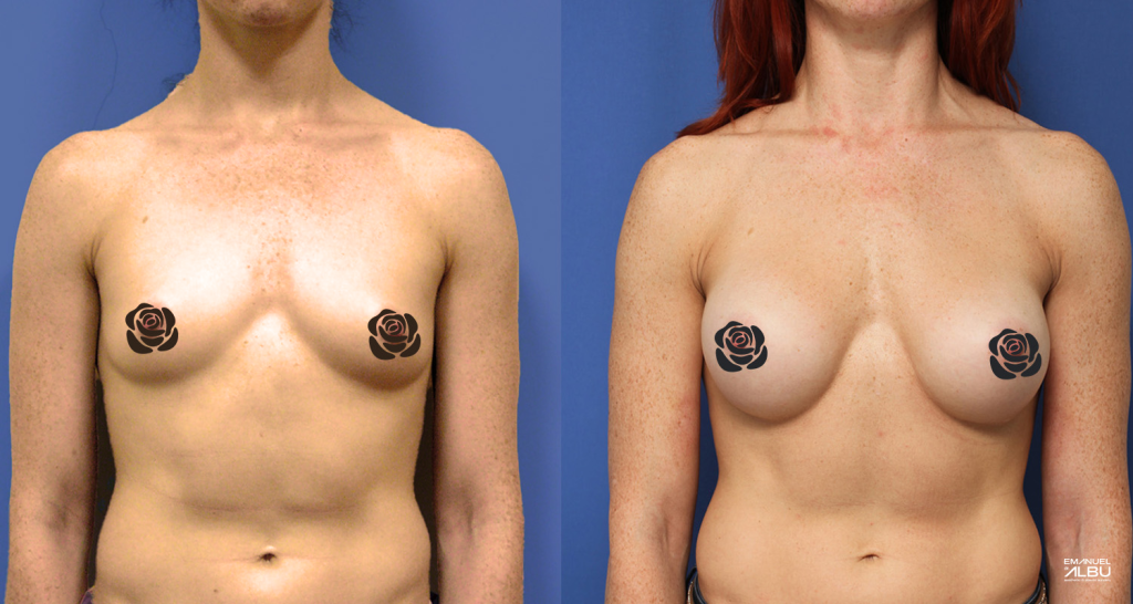 Caz 4. Implant mamar 300 cc. Silicoane bust față.