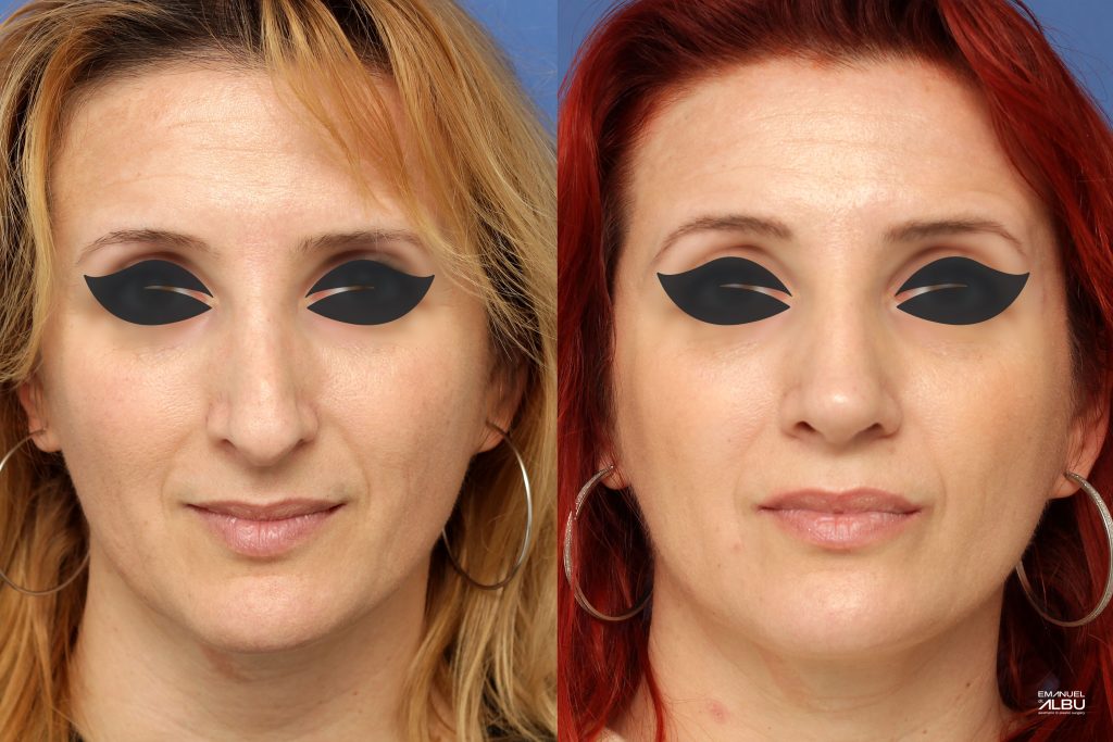 Caz 5. Rinoseptoplastie secundară. Rezultat față.