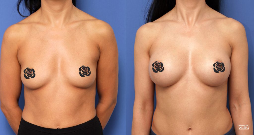 Caz 6. Implant mamar 300 cc. Silicoane bust față.