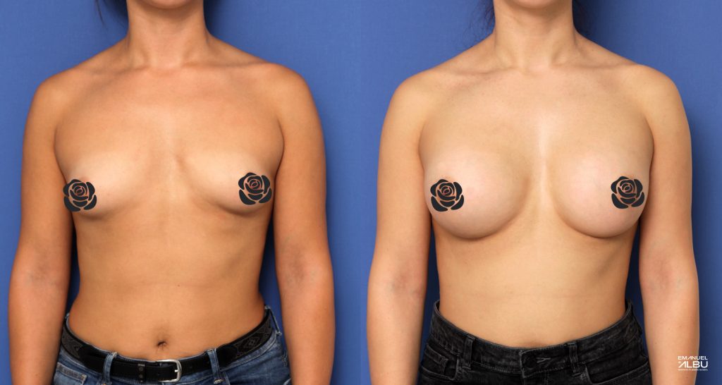Caz 5. Sâni tuberoși. Implant mamar 330 cc. Silicoane bust față.