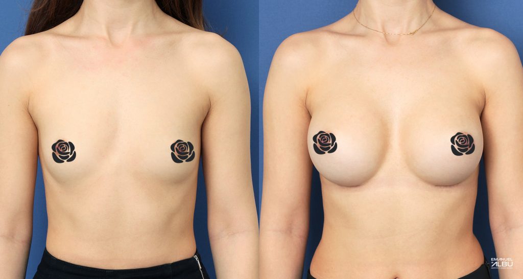 Caz 10. Implant mamar 330 cc. Silicoane bust față.