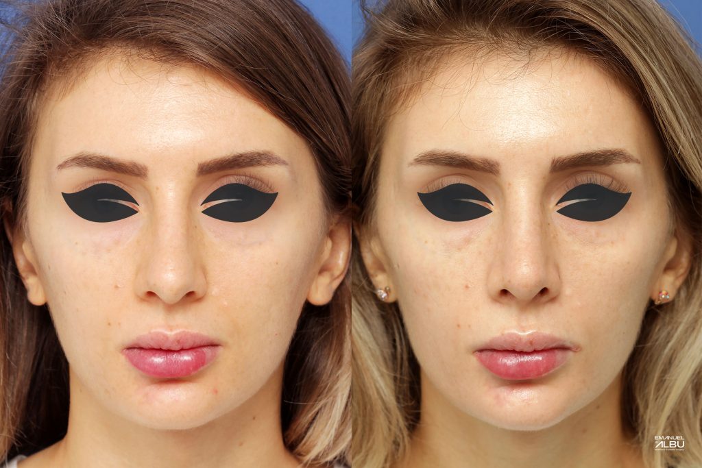 Caz 10. Rinoplastie primară. Rezultat față.