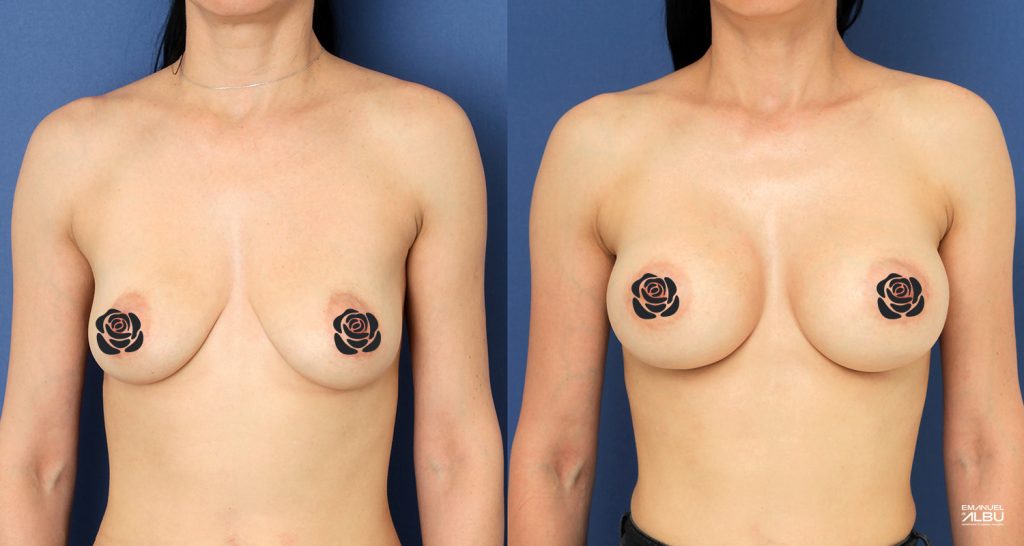 Caz 11. Implant mamar 330 cc. Silicoane bust față.