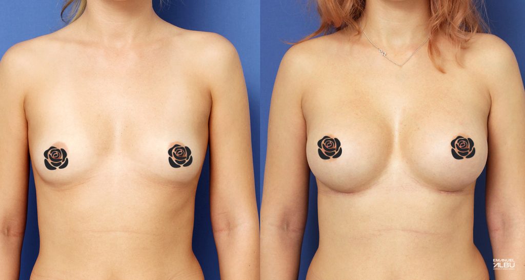 Caz 12. Implant mamar 330 cc. Silicoane bust față.
