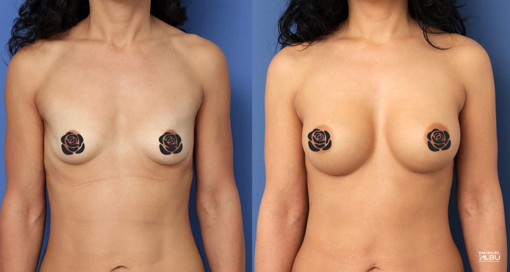 Caz 13. Implant mamar 330 cc. Hipotrofie mamară după naștere. Silicoane bust față.