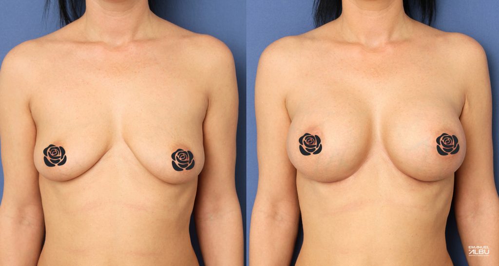 Caz 14. Implant mamar 350 cc. Silicoane bust față.