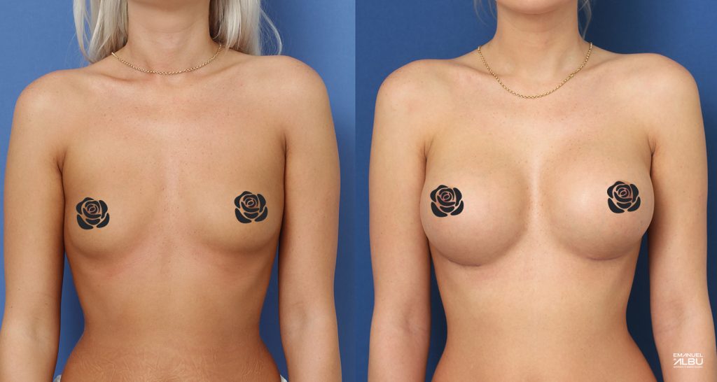 Caz 15. Implant mamar 380 cc. Silicoane bust față.