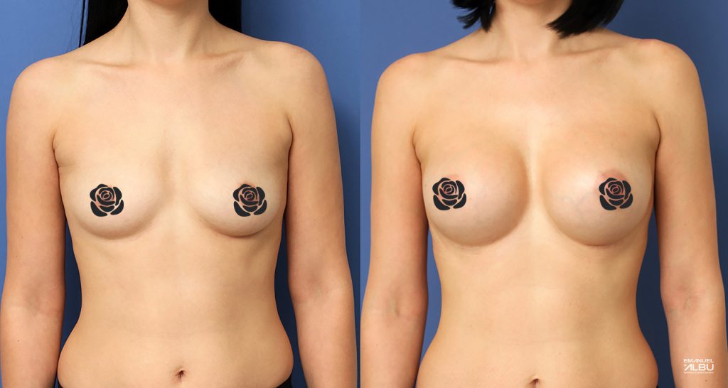 Caz 16. Implant mamar 380 cc. Silicoane bust față.