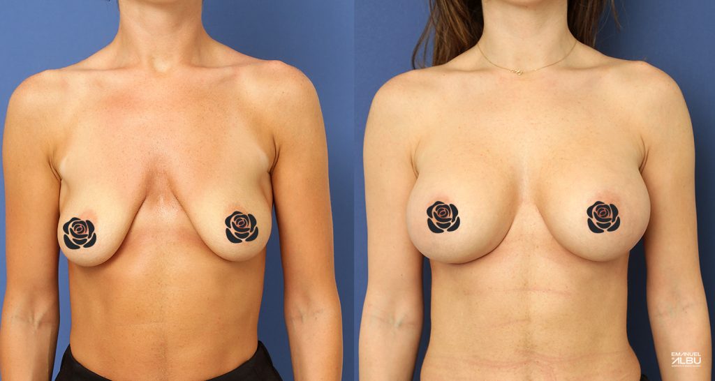 Caz 17. Sâni tuberoși. Implant mamar 430 cc. Silicoane bust față.
