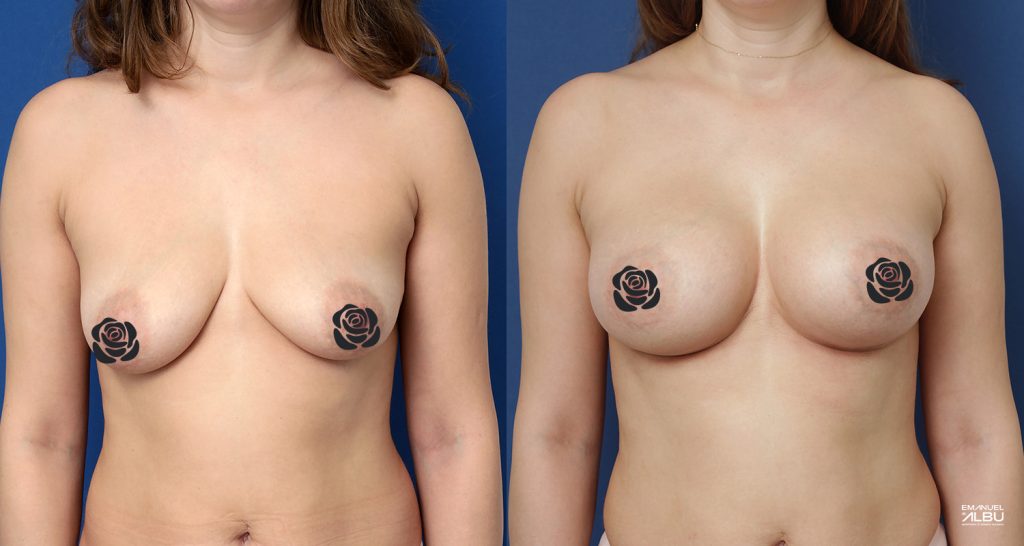 Caz 18. Implant mamar 430 cc. Silicoane bust față.