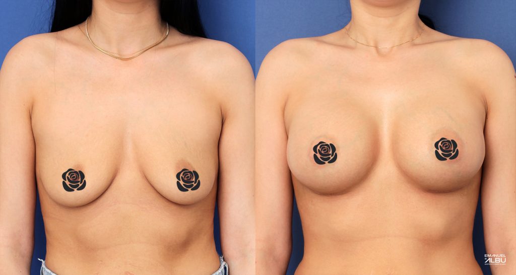 Caz 19. Implant mamar 430 cc. Silicoane bust față.