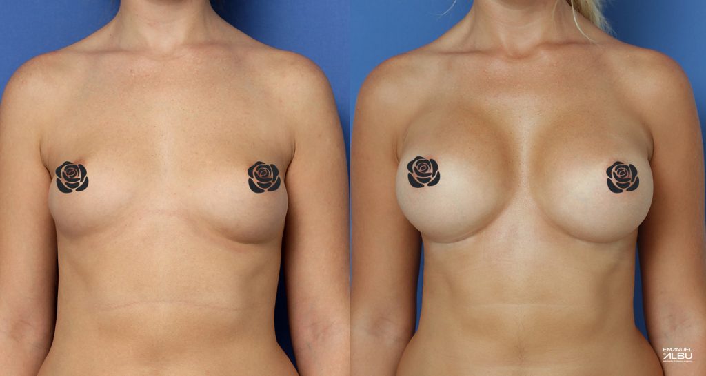 Caz 20. Implant mamar 430 cc. Silicoane bust față.