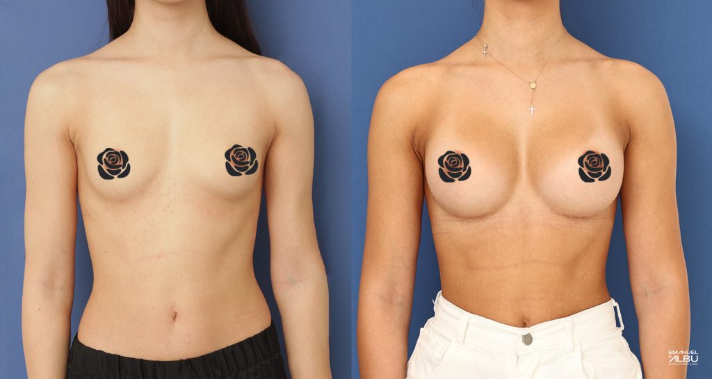 Caz 23. Implant mamar 330 cc. Silicoane bust față.