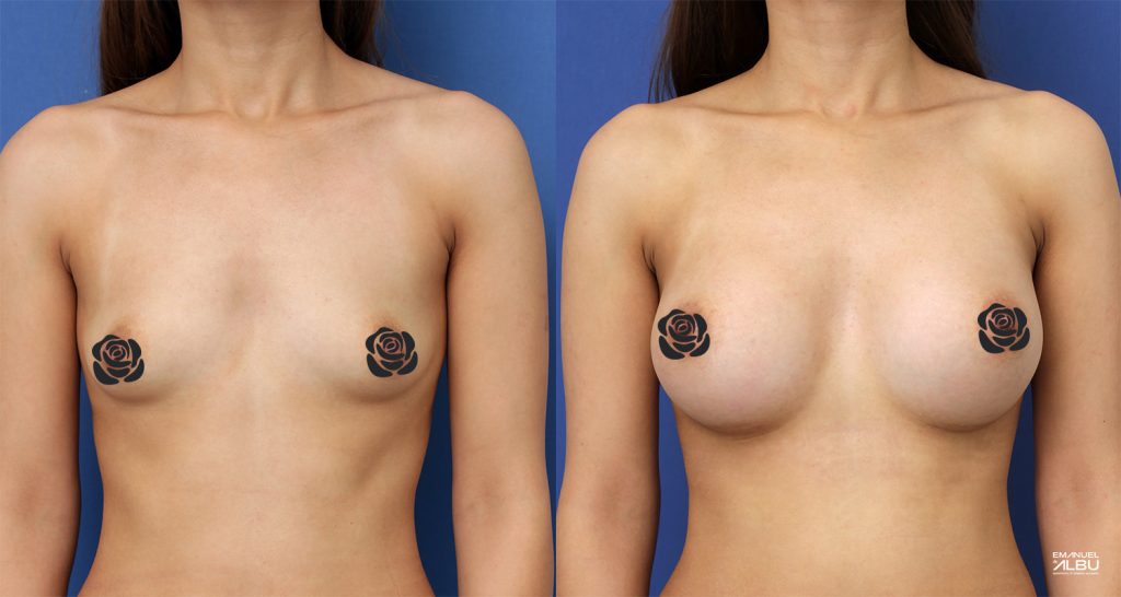 Caz 7. Sâni tuberoși. Implant mamar 330 cc. Silicoane bust față.