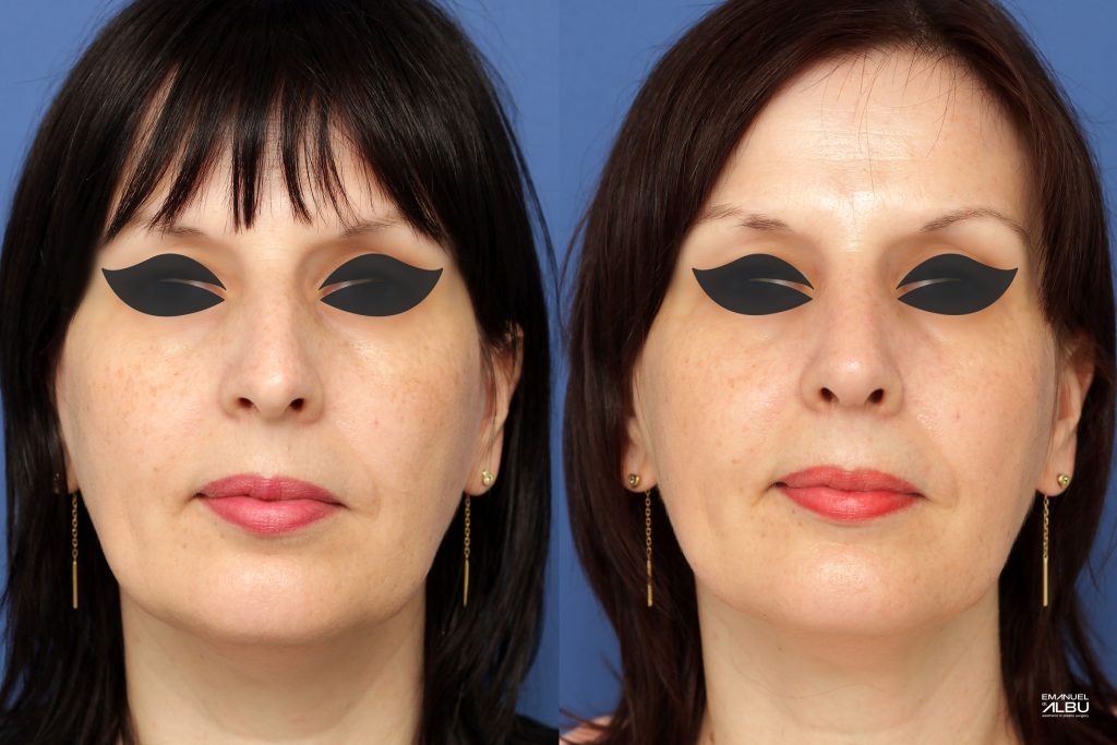 Caz 8. Rinoplastie primară. Rezultat față.