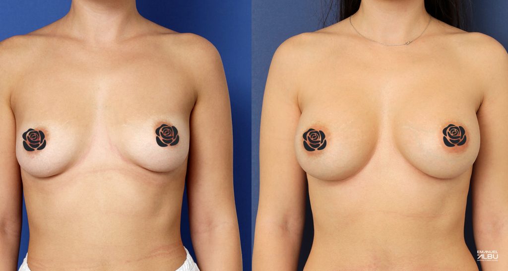 Caz 9. Implant mamar 330 cc. Silicoane bust față.