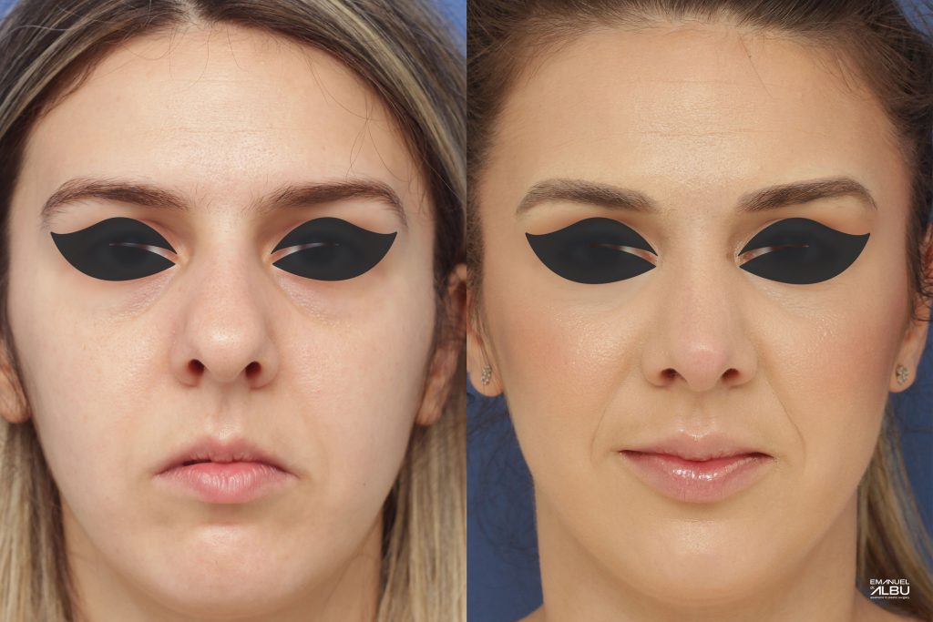 Caz 9. Rinoplastie primară. Rezultat față.