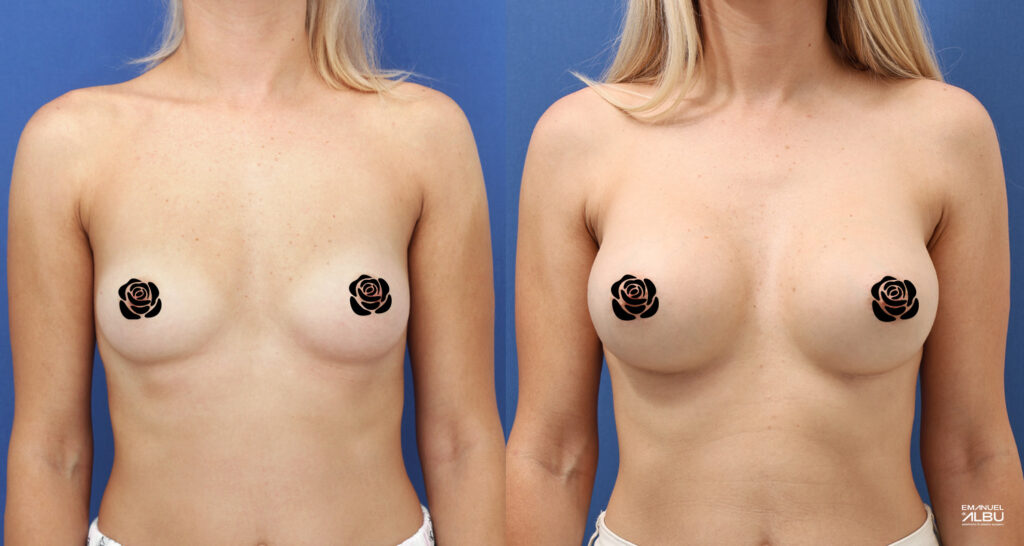 Caz 24. Implant mamar 290 cc. Silicoane bust față.