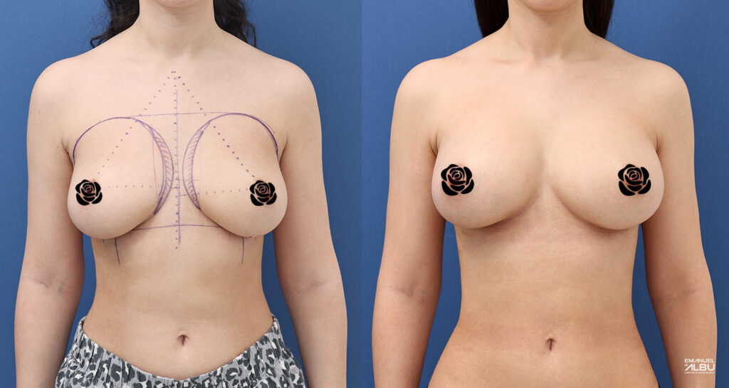 Caz 26. Implant mamar 270 cc. Silicoane bust față.