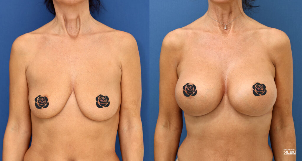 Caz 29. Implant mamar 485 cc. Silicoane bust față.