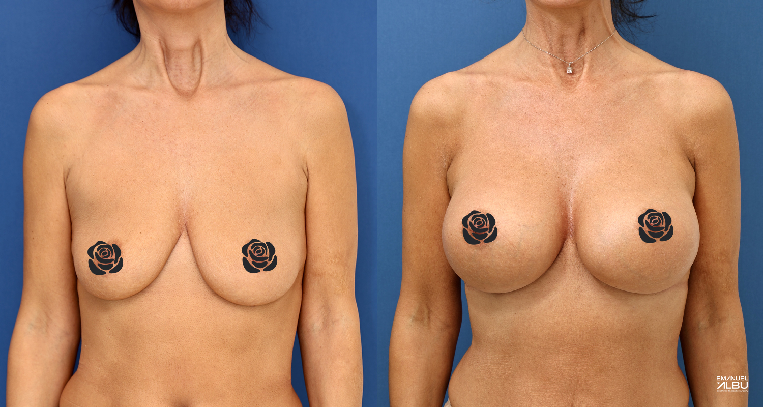 Caz 29. Implant mamar 485 cc. Silicoane bust față.