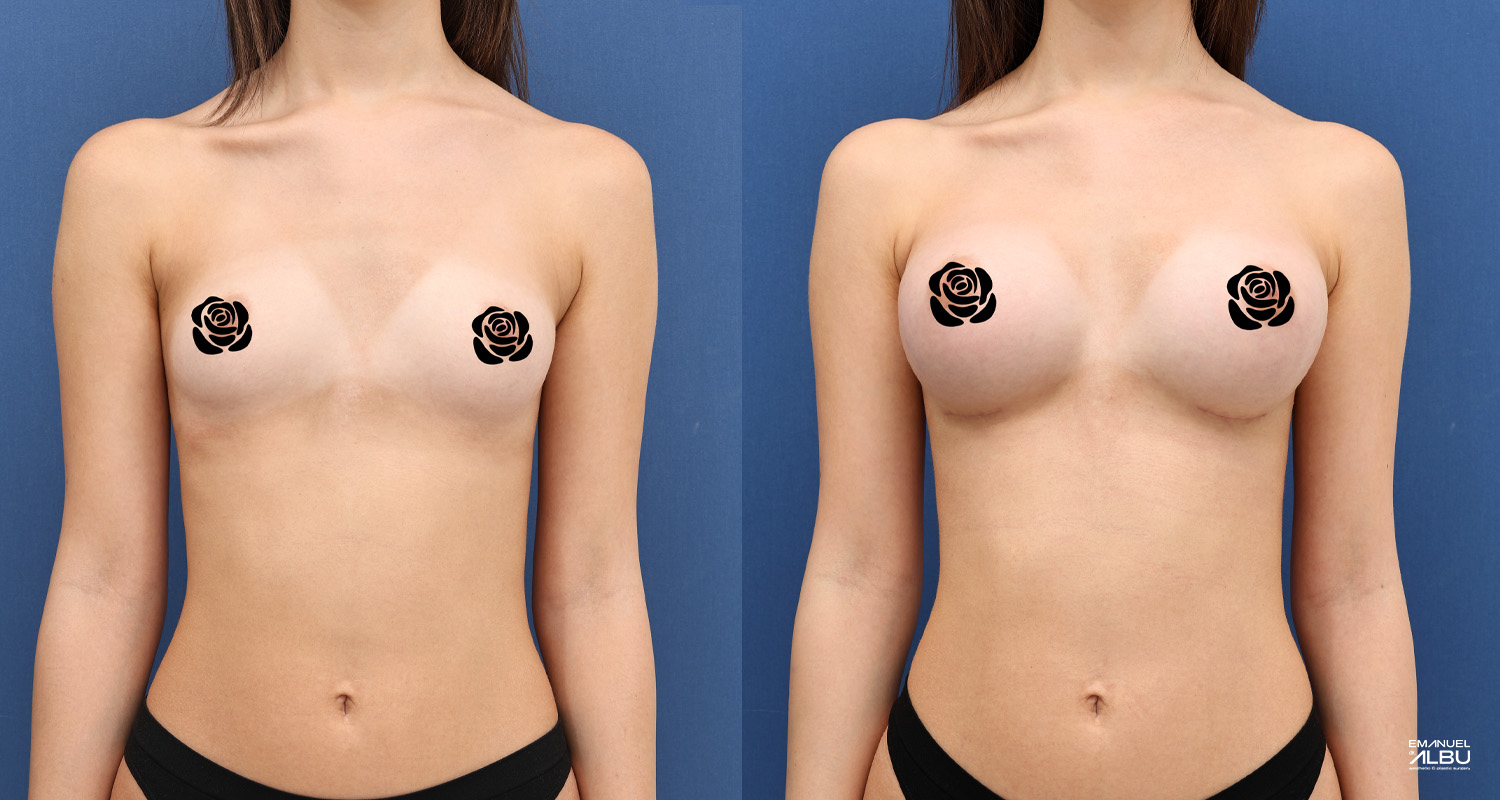 Caz 31. Implanturi de 255 cc și 300 cc pentru asimetrie mamară. Silicoane bust față.