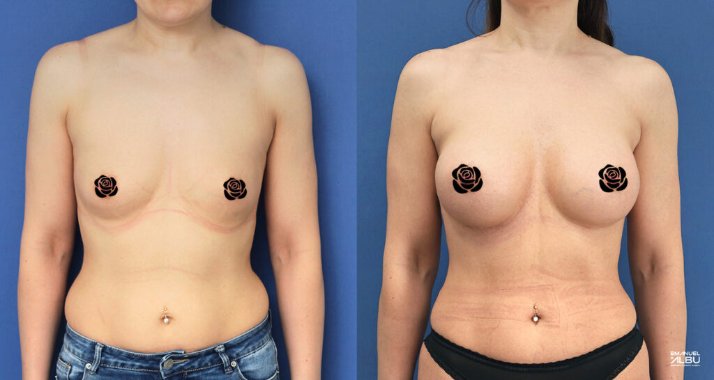 Caz 32. Implant mamar 290 cc. Silicoane bust față.