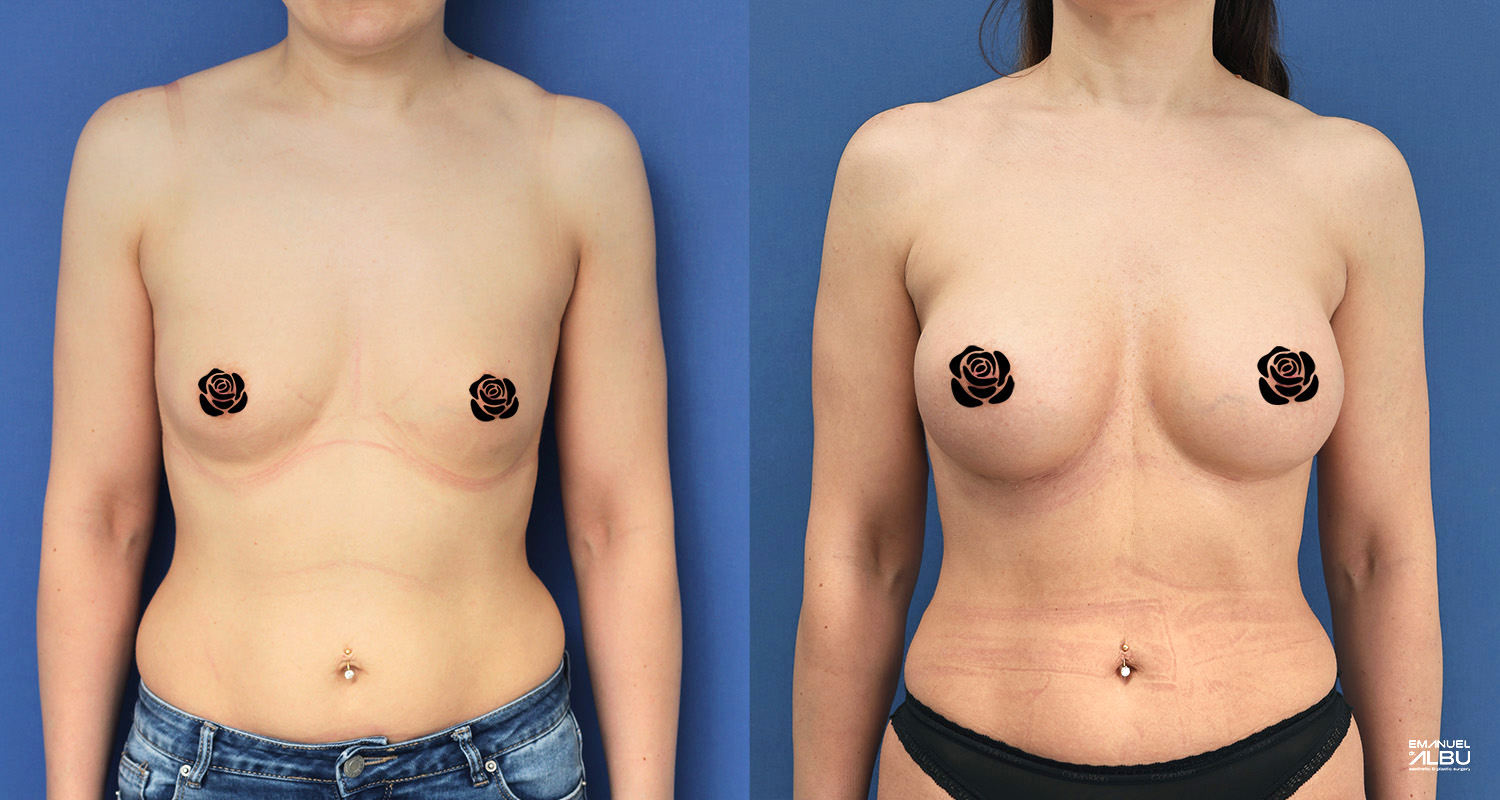 Caz 32. Implant mamar 290 cc. Silicoane bust față.
