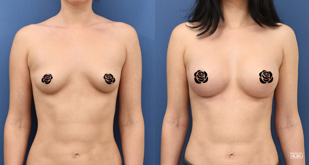 Caz 33. Implant mamar 350 cc. Silicoane bust față.