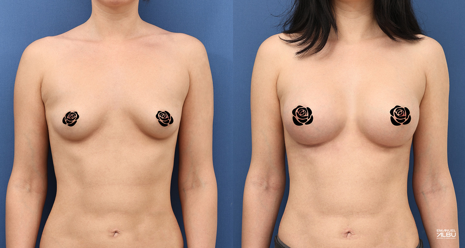Caz 33. Implant mamar 350 cc. Silicoane bust față.